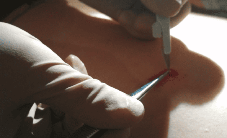 Curación y Retiro de Lesiones Papilomatosas en CDMX: Soluciones Avanzadas en Uroginecología, Ginecología y Obstetricia
