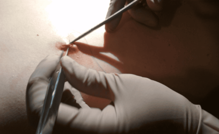Curación y Retiro de Lesiones por Molusco Contagioso en CDMX: Solución Integral en Uroginecología, Ginecología y Obstetricia